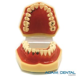 Gum Disease And Caries Dental/Education Demonstration Models