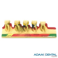 Gum Disease Dental/Education Demonstration Model