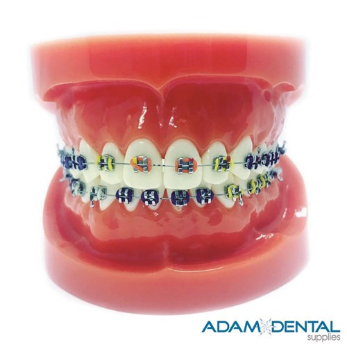 Upper And Lower Arch With Metal Brackets Dental/ Education Demonstration Models