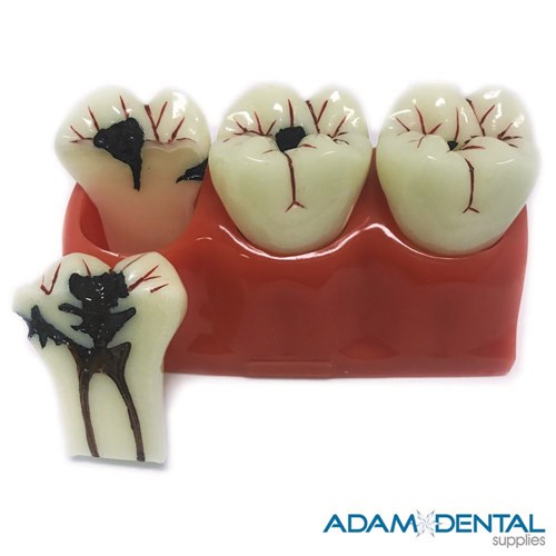 Caries Progressive Oversize Dental/Education Demonstration Models