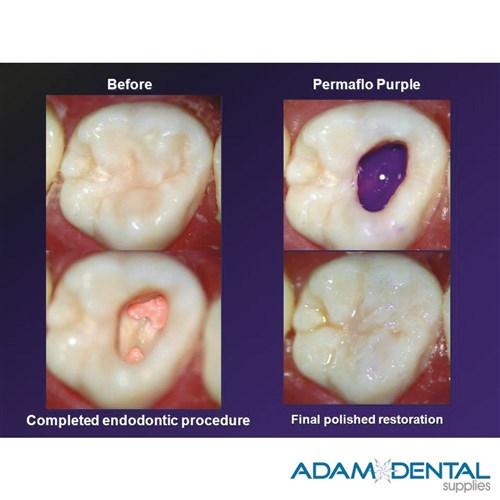 Ultradent PermaFlo Purple Syringe Coronal Seal Identifier